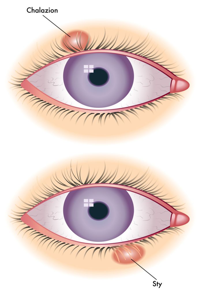 chalazion-soliman-care-family-practice-center-inc